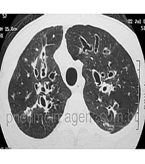 NOVO GUIDELINE SOBRE ATUALIZA��O E CONTROLE DE INFEC��ES EM FIBROSE C�STICA: FA�A O DOWNLOAD.